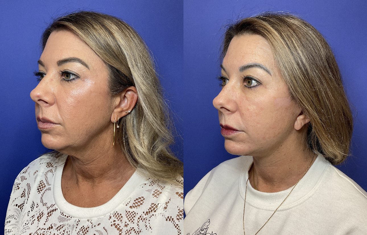 Before and After Photo after Facelift and Necklift