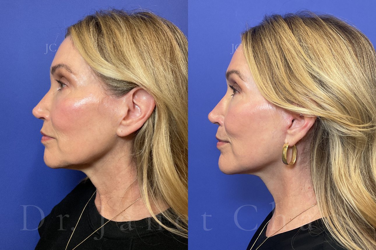 Revision Deep Plane Facelift Necklift before after 15 | Timeless Faces.png
