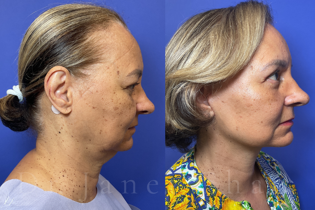 Deep Plane Facelift Necklift Upper Blepharoplasty before after 11 | Timeless Faces.png