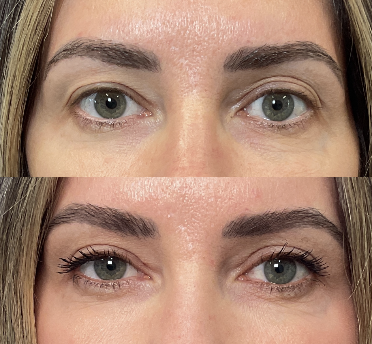 Patient results 6 months after Upper Eyelid Surgery at Timeless Faces