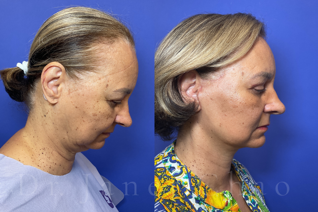 Deep Plane Facelift Necklift Upper Blepharoplasty before after 6 | Timeless Faces.png