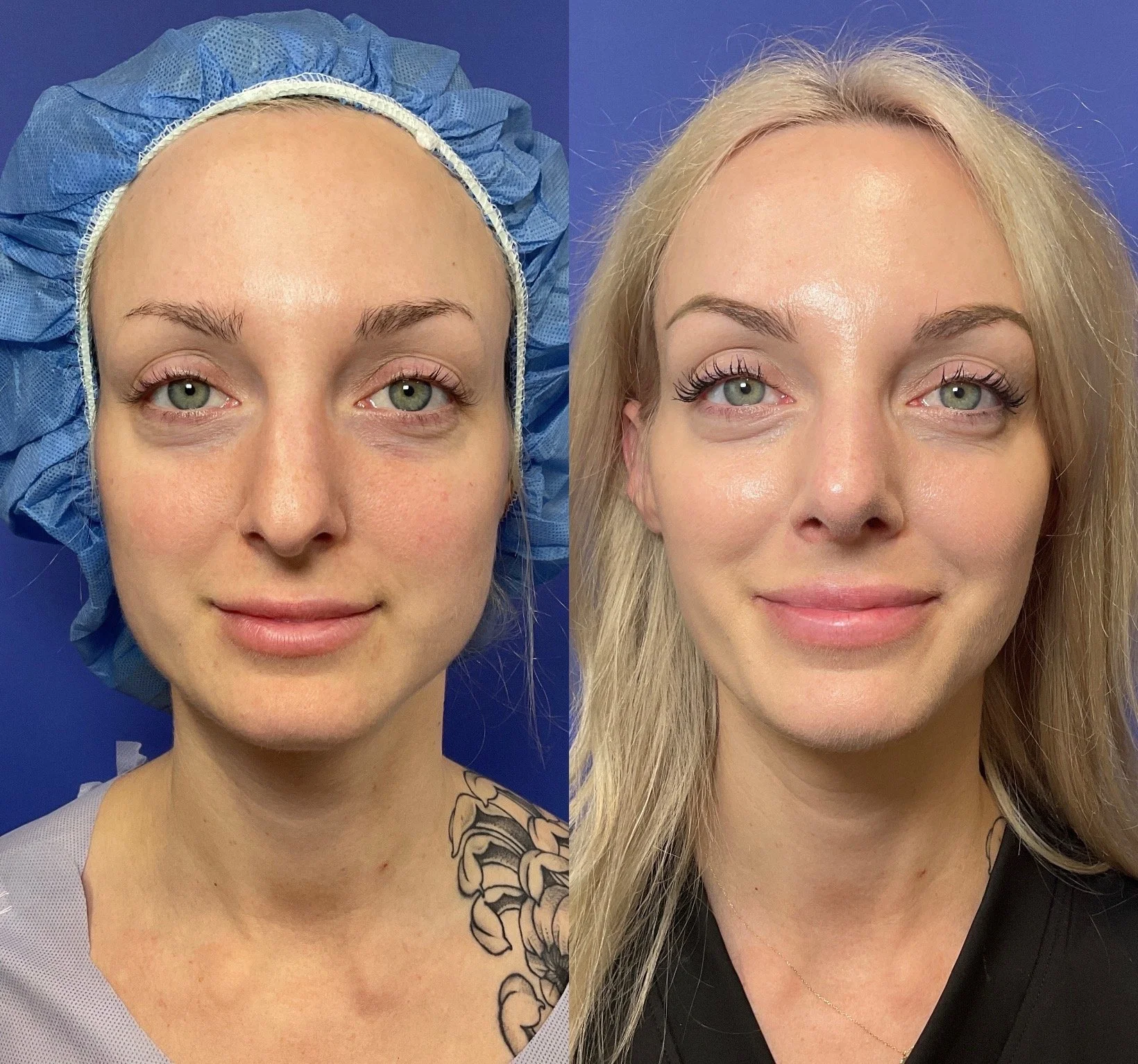 Rhinoplasty Before and After Photo
