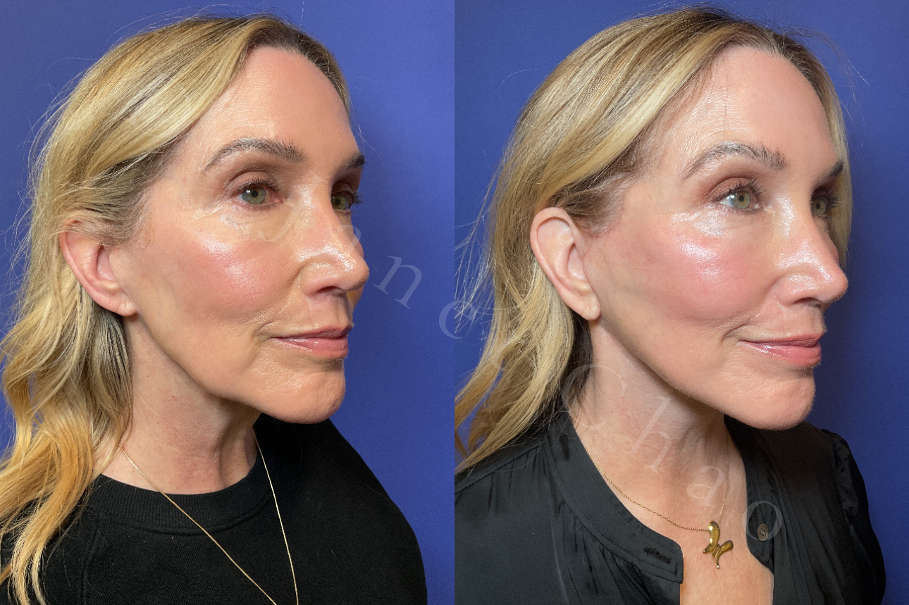 Revision Deep Plane Facelift Necklift before after 6 | Timeless Faces.png