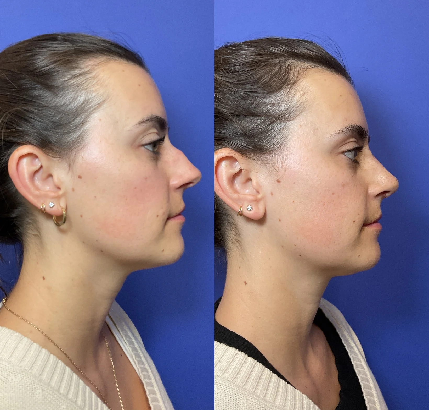 Rhinoplasty Before and After Photo