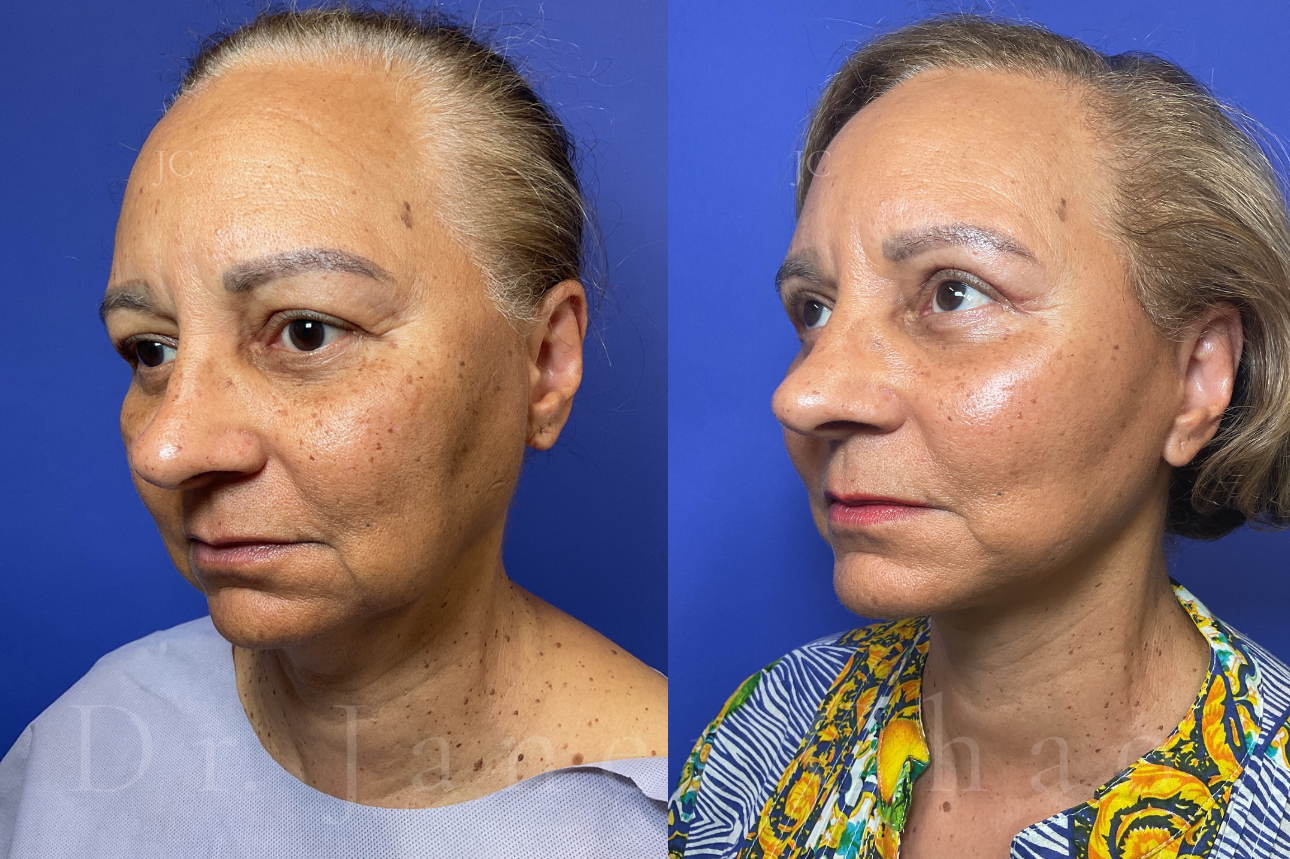 Deep Plane Facelift Necklift Upper Blepharoplasty before after 9 | Timeless Faces.png