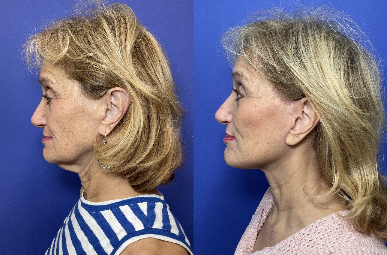 Before and After Photos after Revision Deep Plane Facelift