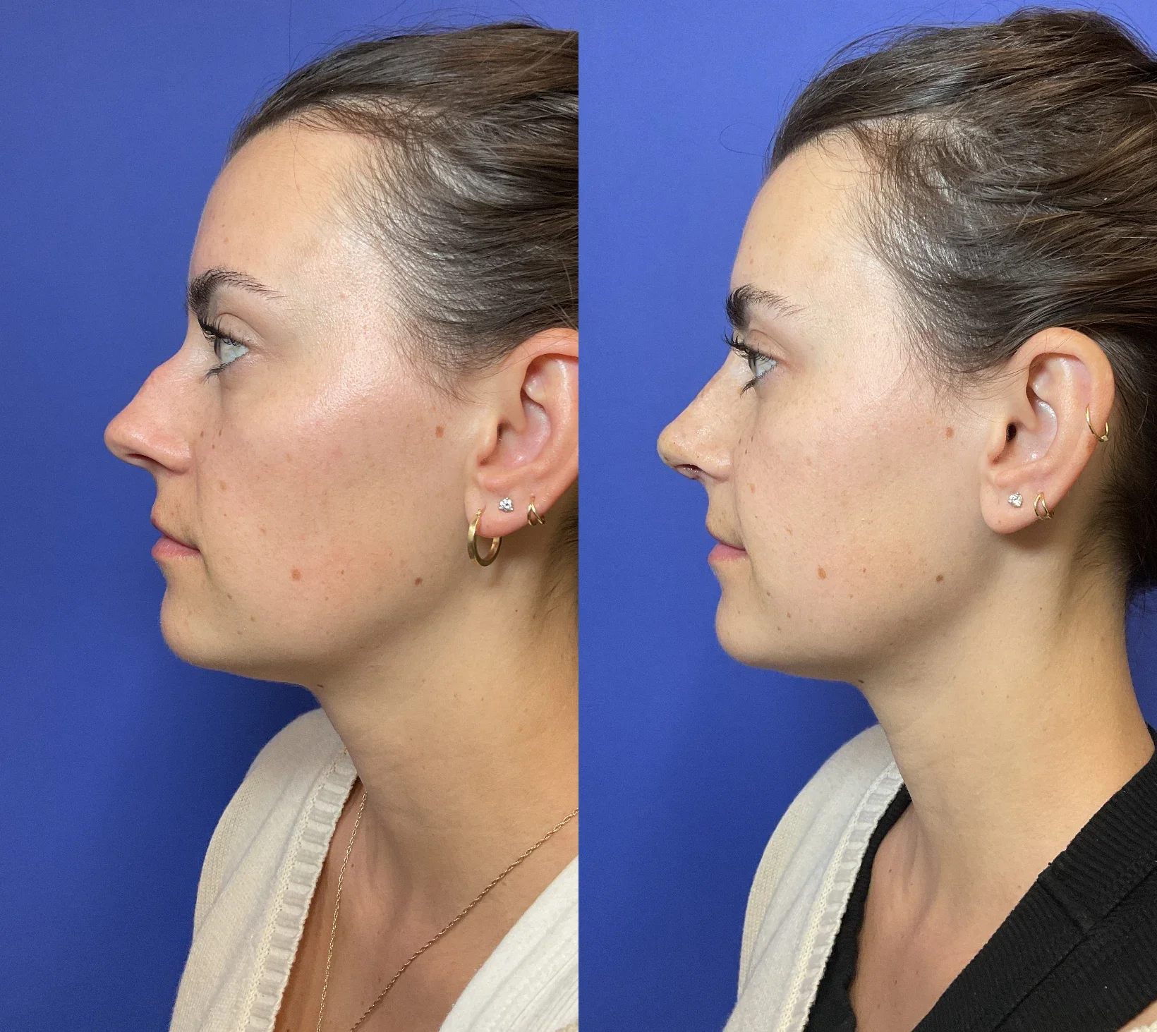 Patient results after Rhinoplasty (Nose Job) at Timeless Faces