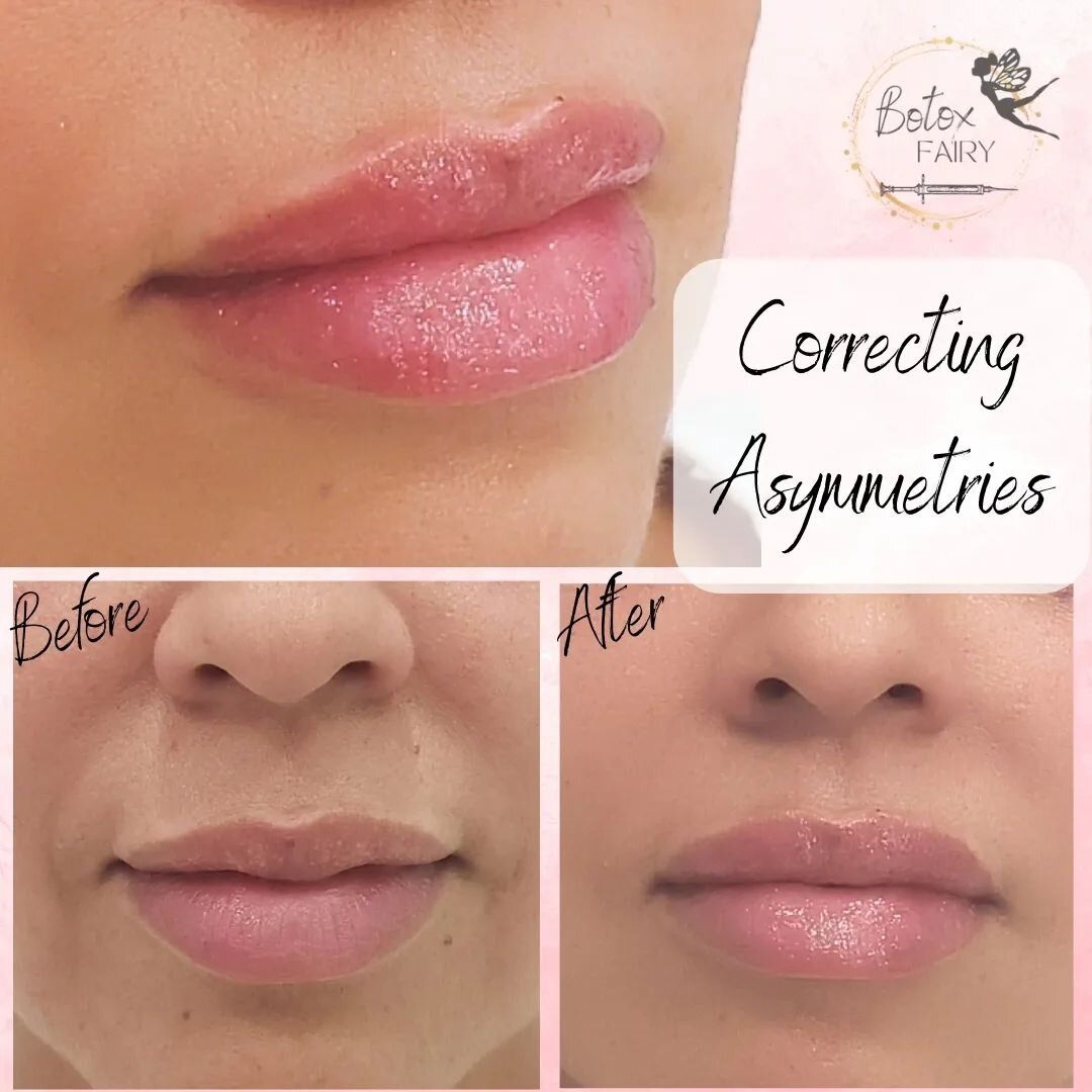Fresh off the needle!&nbsp; This beauty was bothered by the asymmetry of her upper lip and M shape.&nbsp; She's thrilled with her results 💋&nbsp; We injected .8cc into the lips and the rest to soften her smile lines. 

⏰&nbsp; 45 minute appointment 
