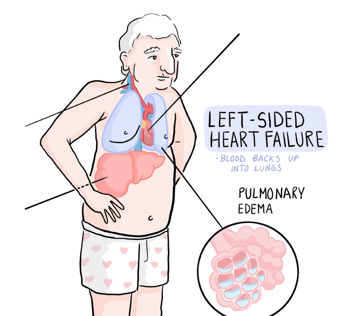 Congestive Heart Failure