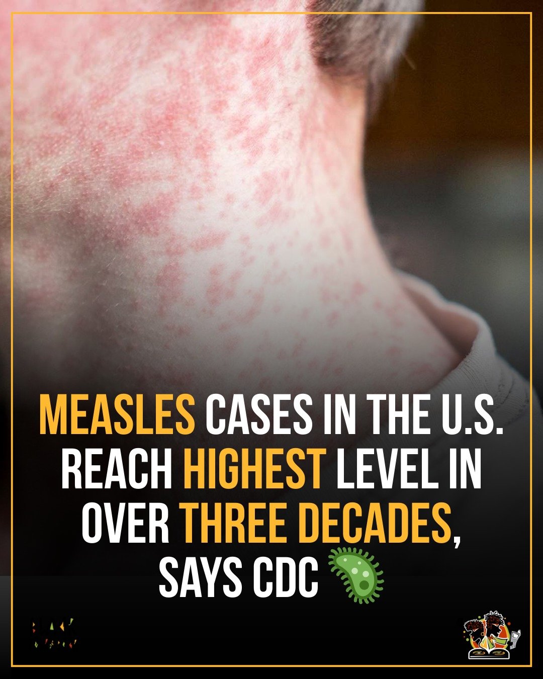 Measles cases in the U.S. have hit their highest point since 1992 — with over 1,200 infections and three deaths. Experts say declining vaccination rates and misinformation are putting communities at risk. Most of the cases are among the unvacci
