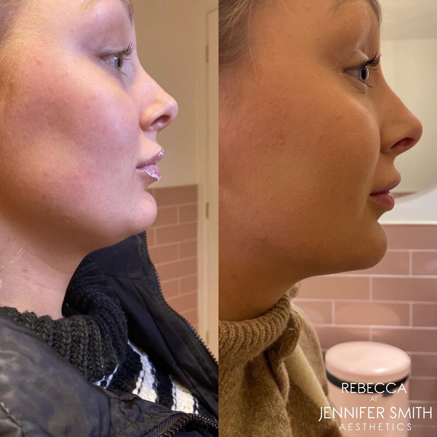 Fat dissolving results after one session 💉✨

Fat dissolving injections break down fat in a controlled way, so your body can safely remove it through its lymphatic system. This simple and effective procedure shrinks double chins as well as improving 