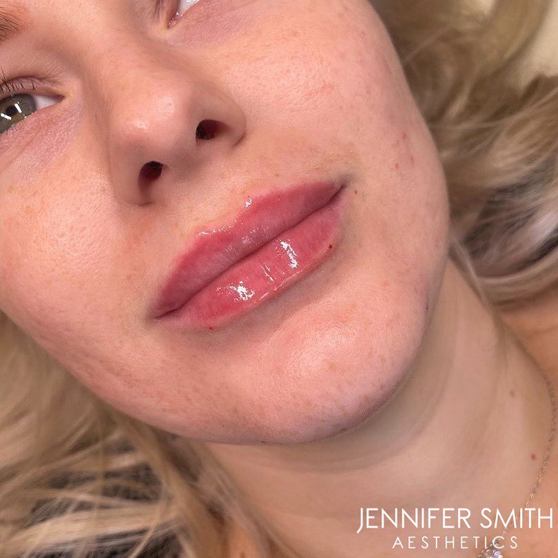 That Cupid&rsquo;s bow and symmetry - lips by Jen 🤩💉✨