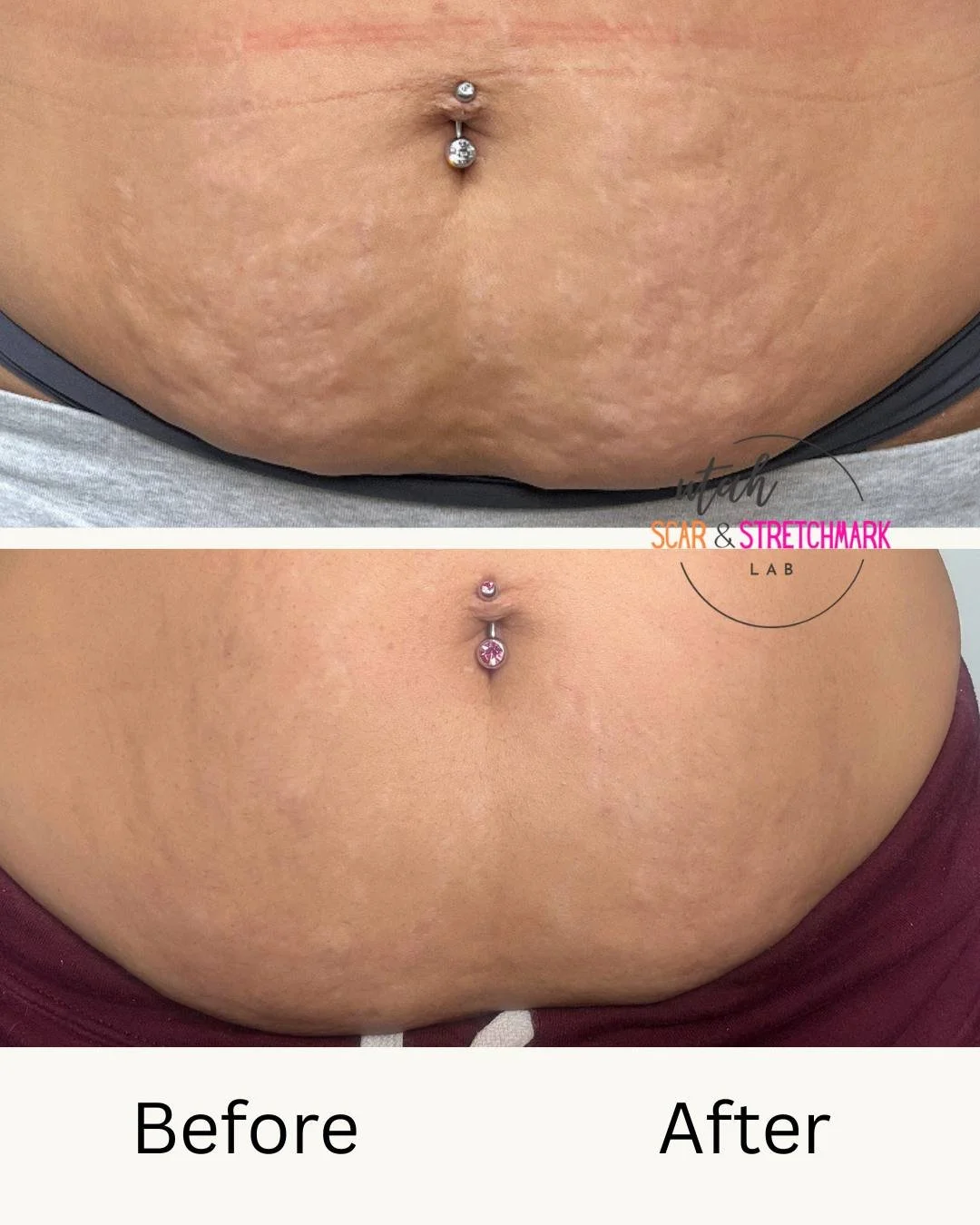 pregnancy stretch marks treatment utah