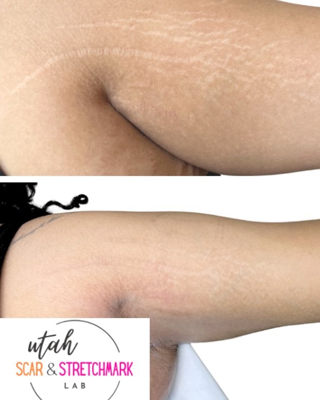 After one session of camouflage tattoo.  One of the best things about tattooing stretch marks is the natural melanin production that helps to fill in the color of the stretch marks.  As you can see here, our stretch marks are no longer white.  We sti