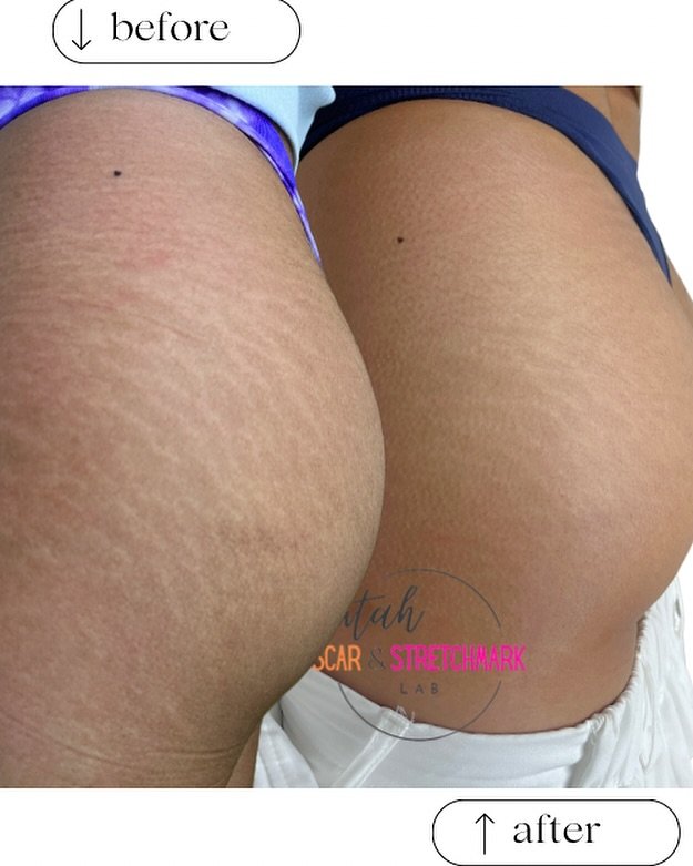 After just one session with me!  Today, we did her second session. Stay tuned for those results. To book your appointment, visit the link in my bio. No deposit required.