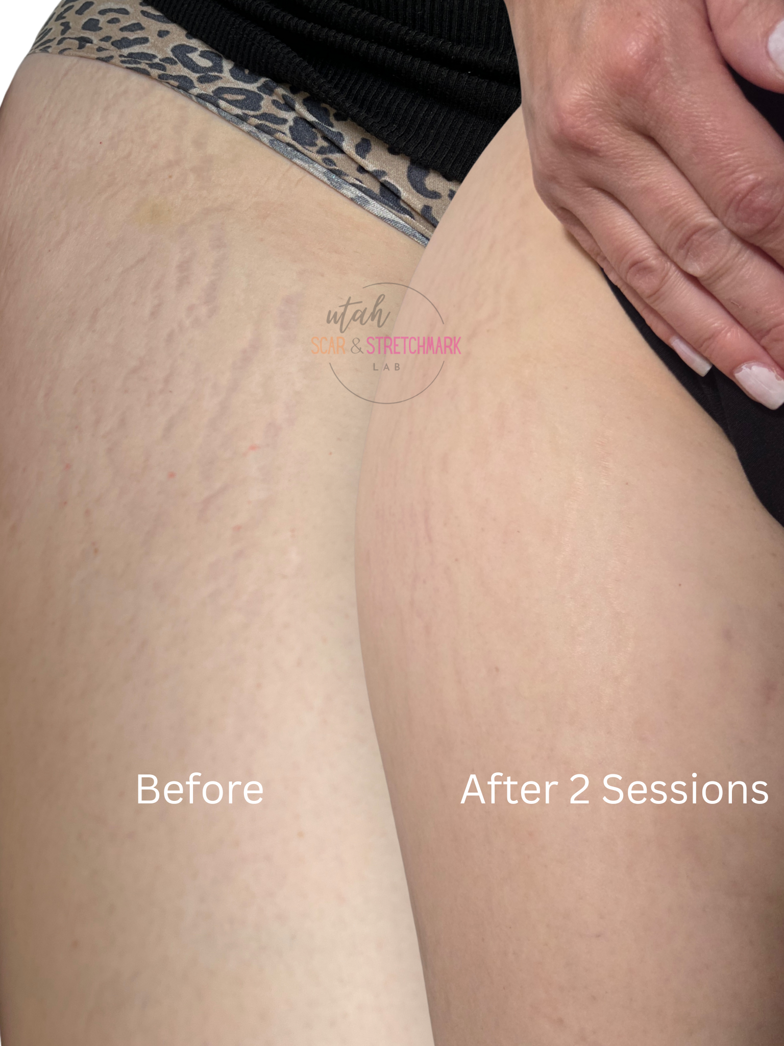 stretch mark treatment before and after thighs