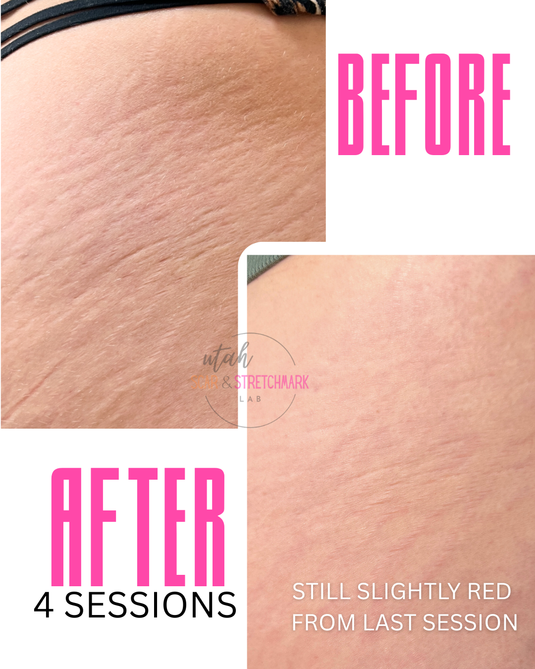 stretch marks on butt before and after