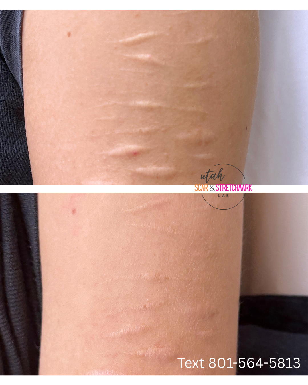 self harm scar treatment utah before and after