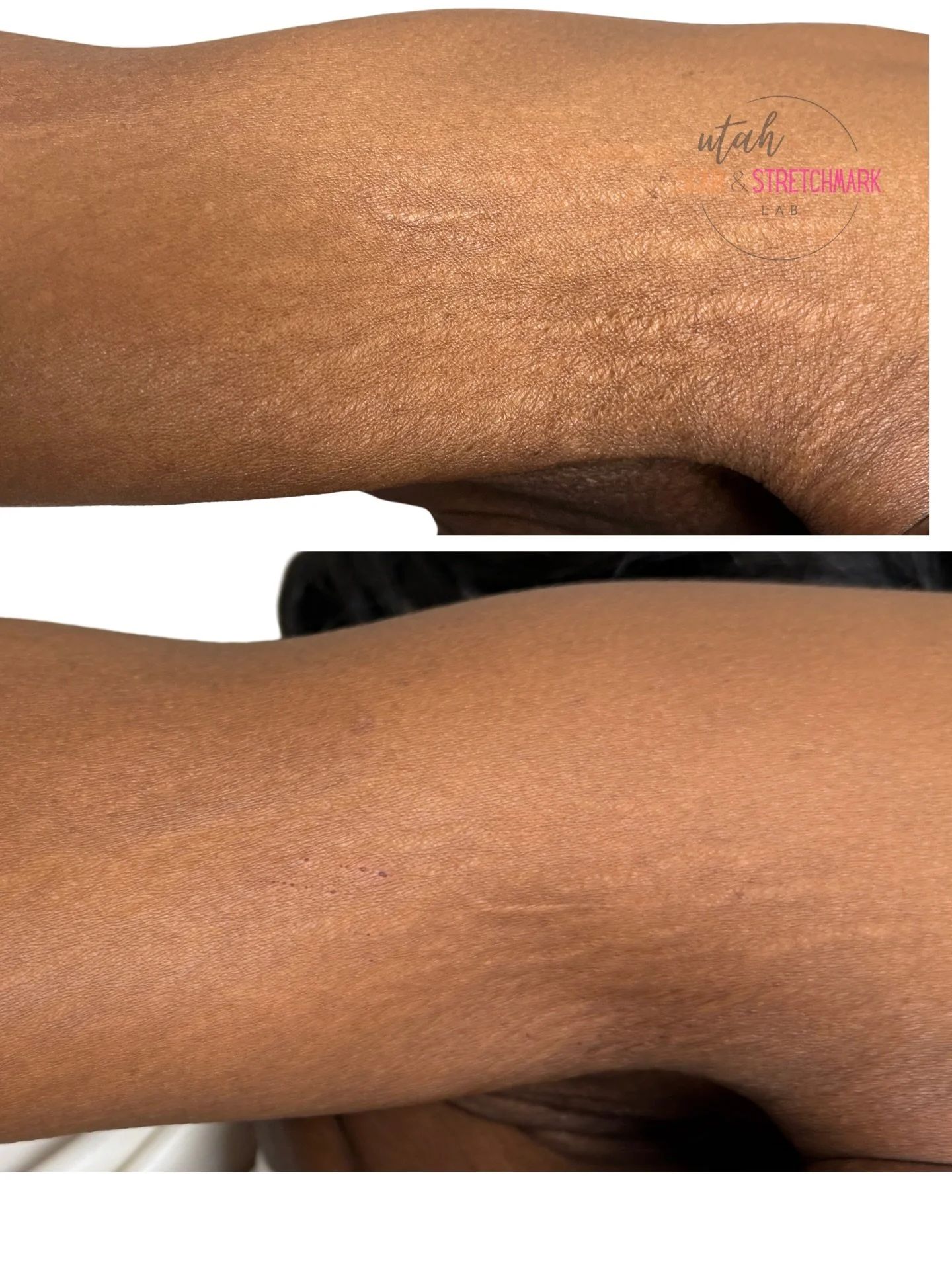 Can you believe my students did this during a training?  After just one session, we have a decent 40% improvement in the texture and color of these stretch marks.  I am so proud of my students. 🙌🏼