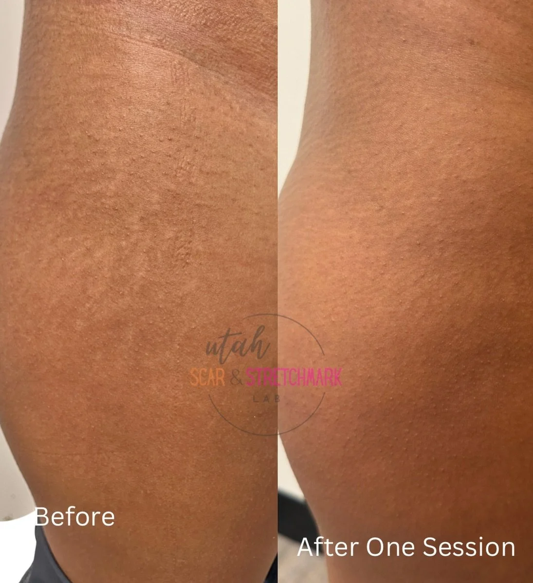 Thigh stretch marks after one session.