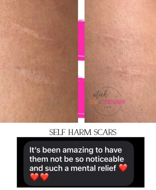 Self harms scars are my FAVORITE tattoo.  The results are life changing and a great camouflage gives my clients the fresh start they deserve ❤️
This is after just one session of camouflage tattoo. We plan on doing one more session for extra blending.