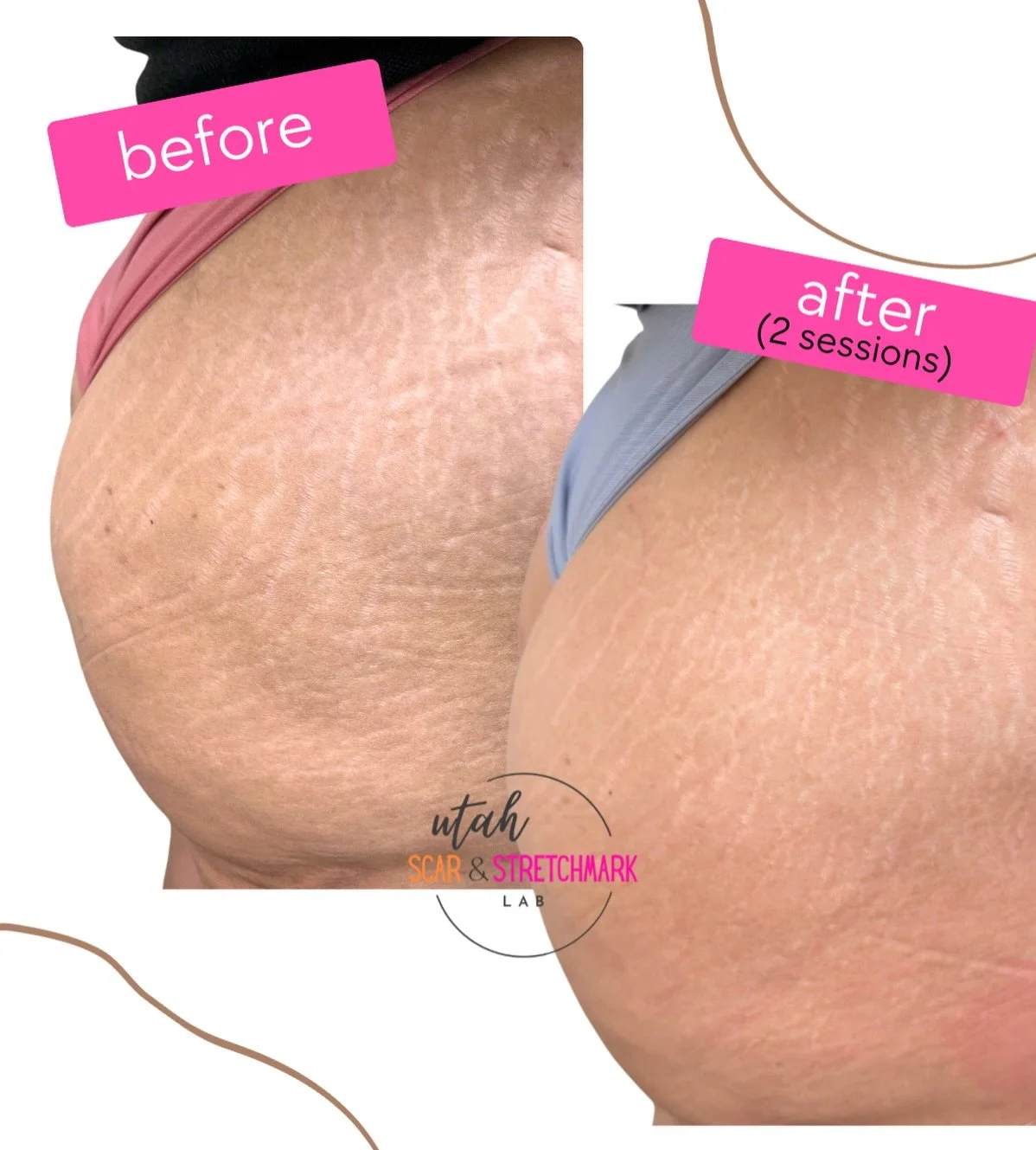 After two sessions, her stretch marks are much less noticeable.  We still have one to two sessions to go for optimal results, but so far so good. 🙌🏼

Needle: 7cm &amp; 11cm
Ink Dilution: 80%
Voltage: 7.2
Stroke setting: 2.2

If you appreciate the e