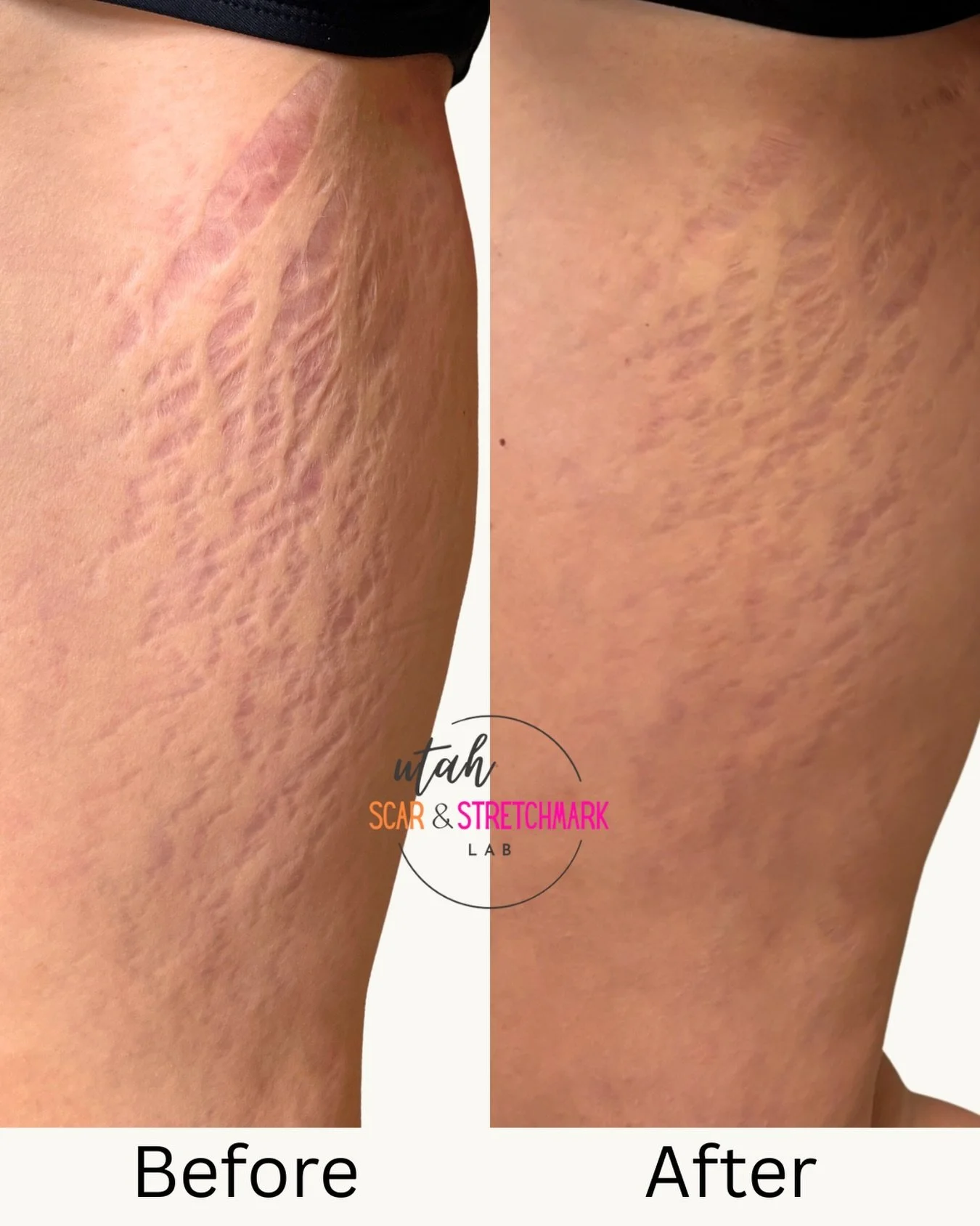 ✨ Look at these results after just ONE session! ✨
Tattooing is incredible for restoring color&mdash;but there&rsquo;s an added bonus people don&rsquo;t talk about enough: texture improvement.

When tattoo needles enter the skin at a 45&deg; angle, th