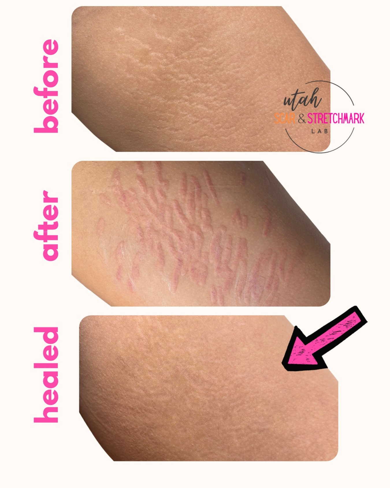 You can expect your tattoo to take approximately 2&ndash;6 weeks to fully heal. Stretch mark tissue responds differently to tattooing than healthy skin, so the healing process can look a little different. Immediately after your session, the area will