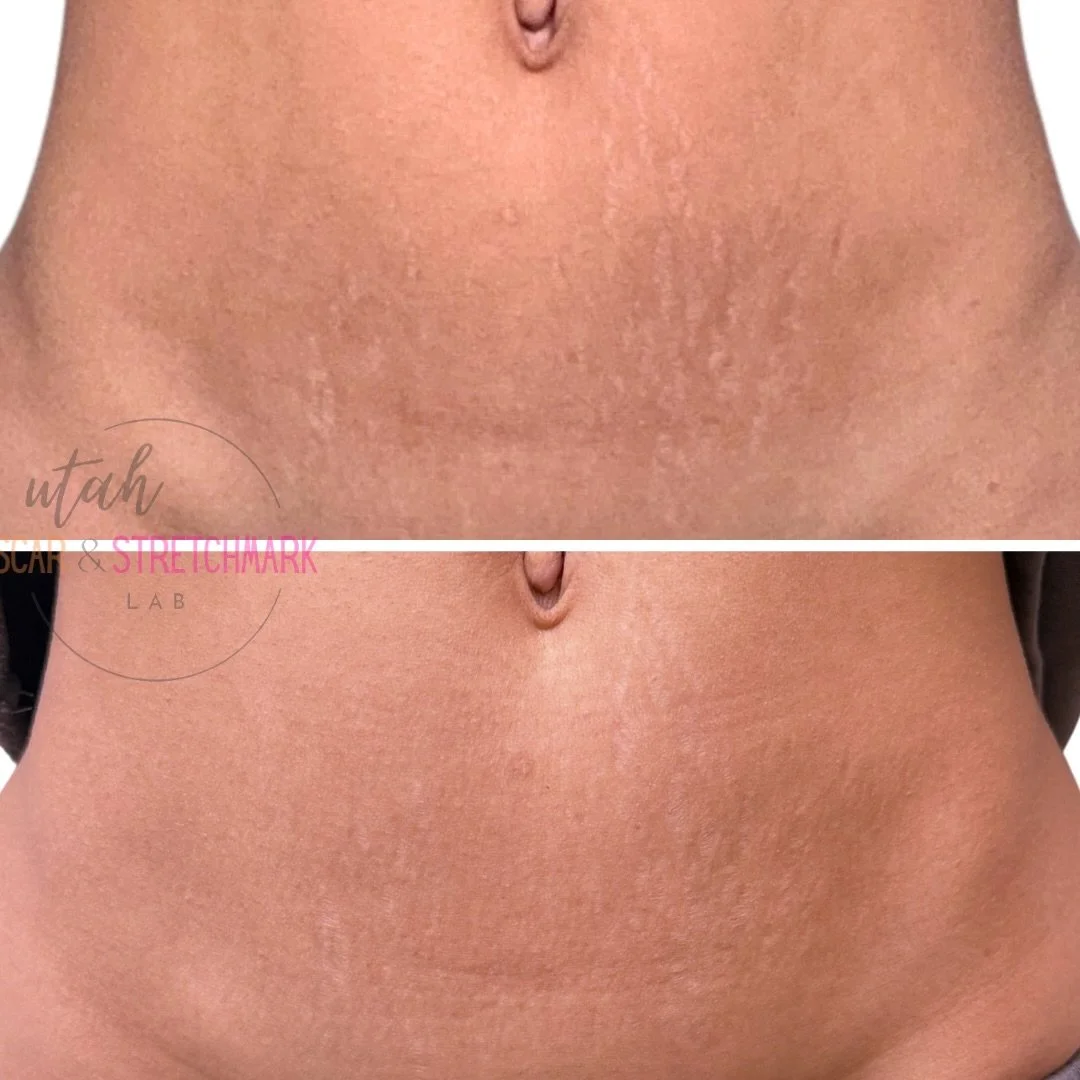 These results belong to one of my favorite humans and a true skincare expert. Being trusted with her skin is always an honor ❤️
Today was session two. More to come.

#paramedicaltattoo #stretchmarks #stretchmarktattoo #camouflagetattoo #stretchmarksb