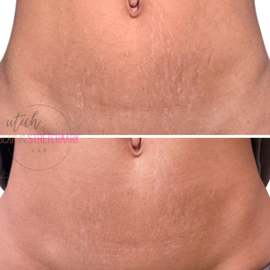 These results belong to one of my favorite humans and a true skincare expert. Being trusted with her skin is always an honor ❤️
Today was session two. More to come.

#paramedicaltattoo #stretchmarks #stretchmarktattoo #camouflagetattoo #stretchmarksb