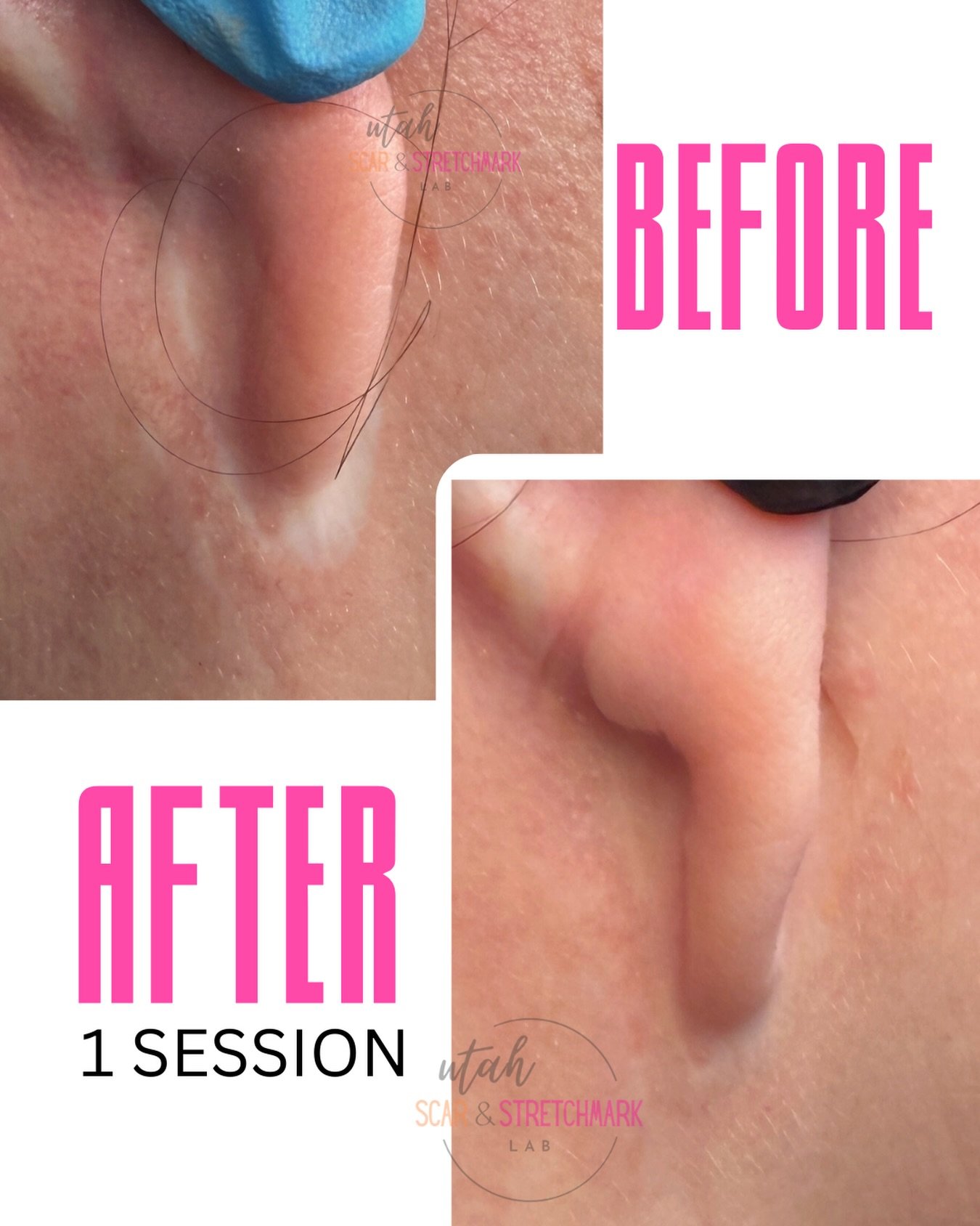 Close-up of the area around the earlobe treating a facelift scar after one session. The client still has two sessions remaining.
Note to self: next time, move all hair completely out of the frame for photos

#paramedicaltattoo #faceliftscar #scarcamo