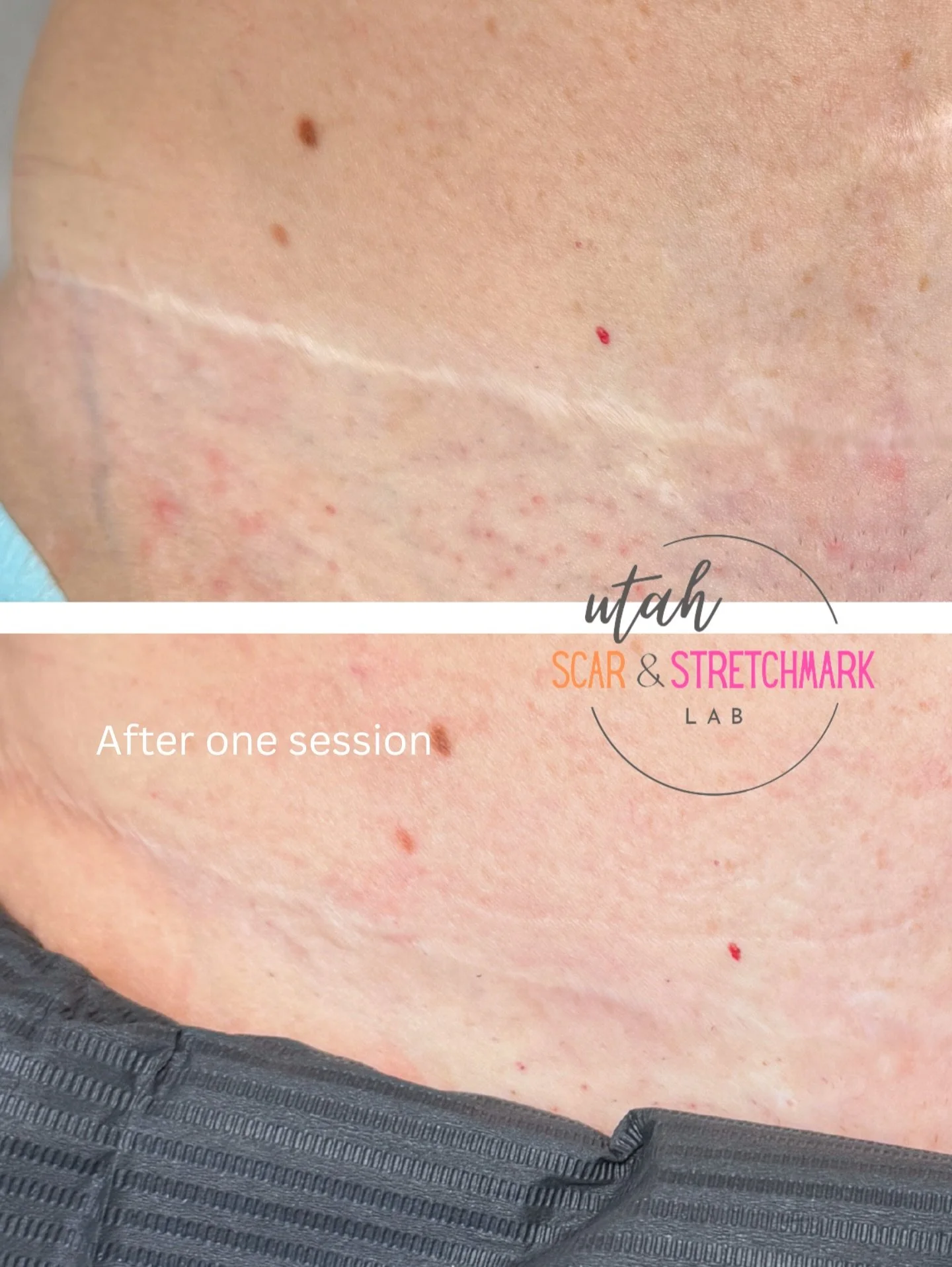Tummy tuck scar after just ONE session of camouflage tattoo.  #tummytuck #scartreatment #scarremoval #beforeandafter re