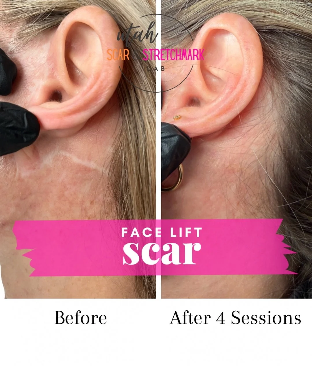 An unfiltered look at camouflage tattoo. This client is extremely happy with her results.  And you would never guess that she has had a facelift.  If you want your surgical scars to be more discreet, send me a message for a free quote!