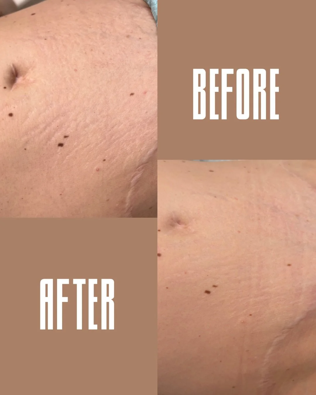 What if I told you a tattoo could actually improve the texture of your skin and the appearance of stretch marks?

My technique uses a soft, custom ink blend to subtly tint the skin while the tattooing process itself stimulates maximum collagen produc