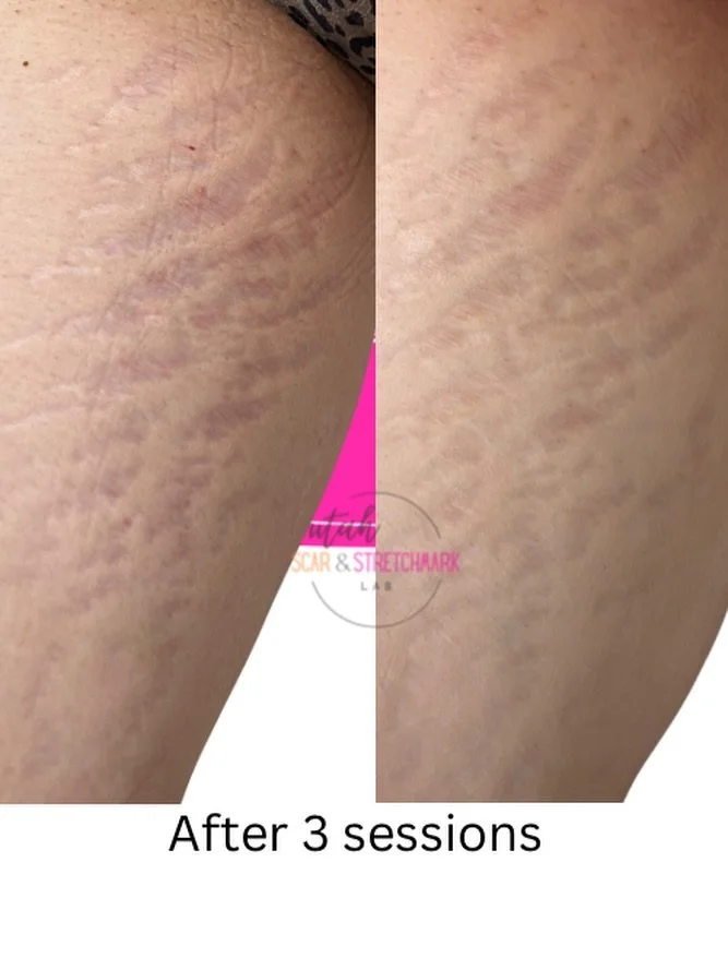 These are the HARDEST stretch marks to work on, but as long as the client is committed to the process, the results can be phenomenal.  She will need 3-4 more sessions for best results, but so far, we have a decent improvement ❤️
#stretchmarkremoval #