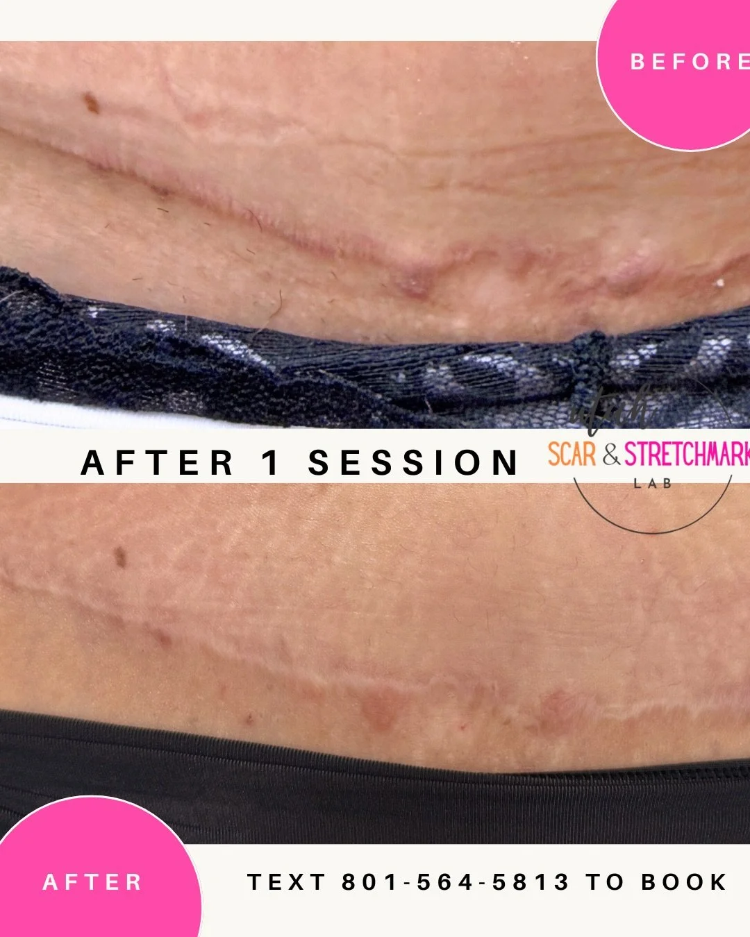 After one session of camouflage tattoo.  I am able to correct both color and texture which makes tattoo a unique and effective solution to any scar. 
#camouflagetattoo #paramedicaltattoo #tummytuck #tummytuckscar