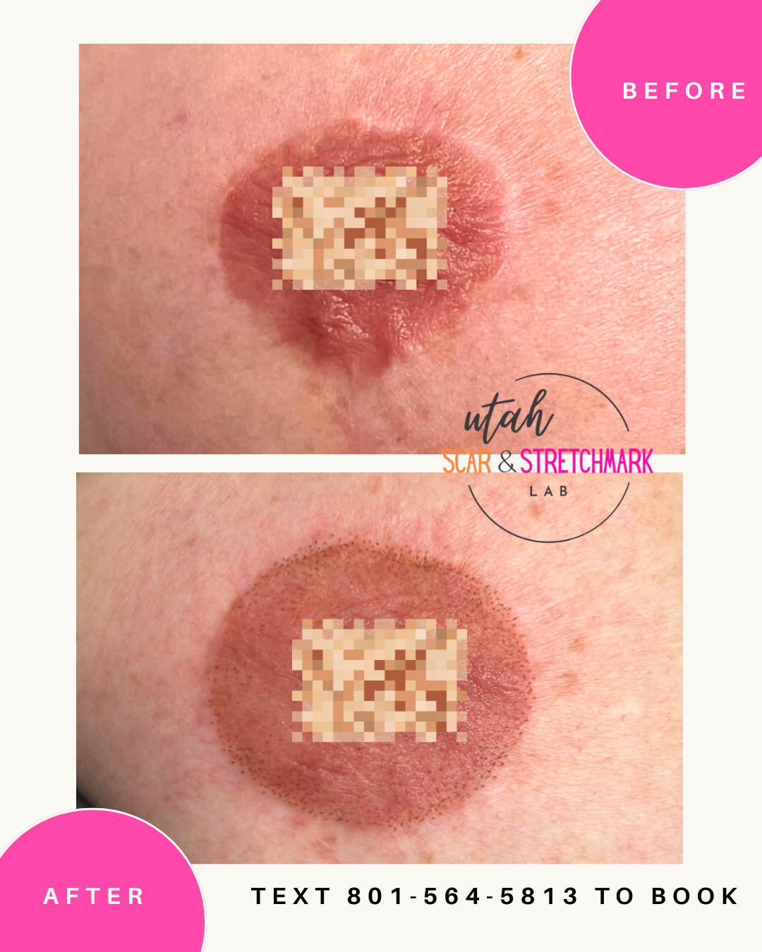 Breast lift scar camouflage