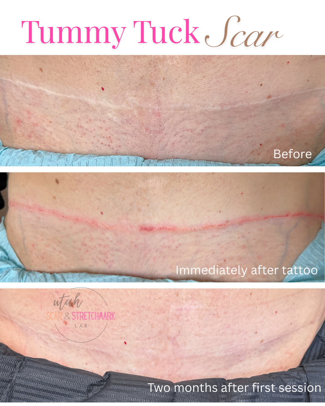 Tummy tuck scar treatment before after Utah