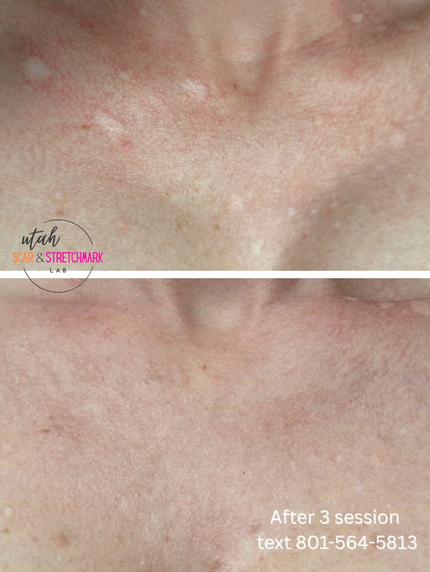 Zoom in 🙌🏼
These hypopigmented scars have been quite the challenge.  This was my third session with this client who had actually gone to another artist in another state before finding me. I knew retention was going to be tough because another artis