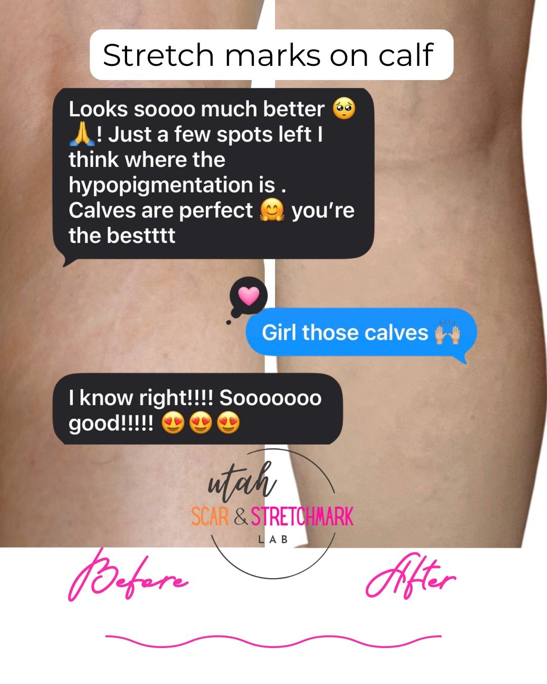 One of my favorite memories from last year was flying to Trinidad to erase these stretch marks from her calves. I&rsquo;m always so honored when clients from other countries value my work enough to not only invest in their tattoo, but also invite me 