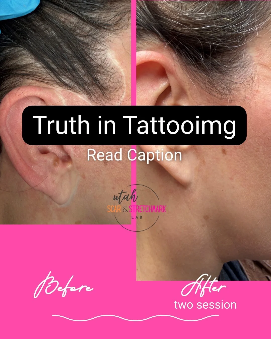 Sometimes after a tattoo session, certain areas heal beautifully while others still need a little more attention. Showing only one angle wouldn&rsquo;t feel completely transparent.

So here you&rsquo;ll see a before-and-after of the portion of her sc