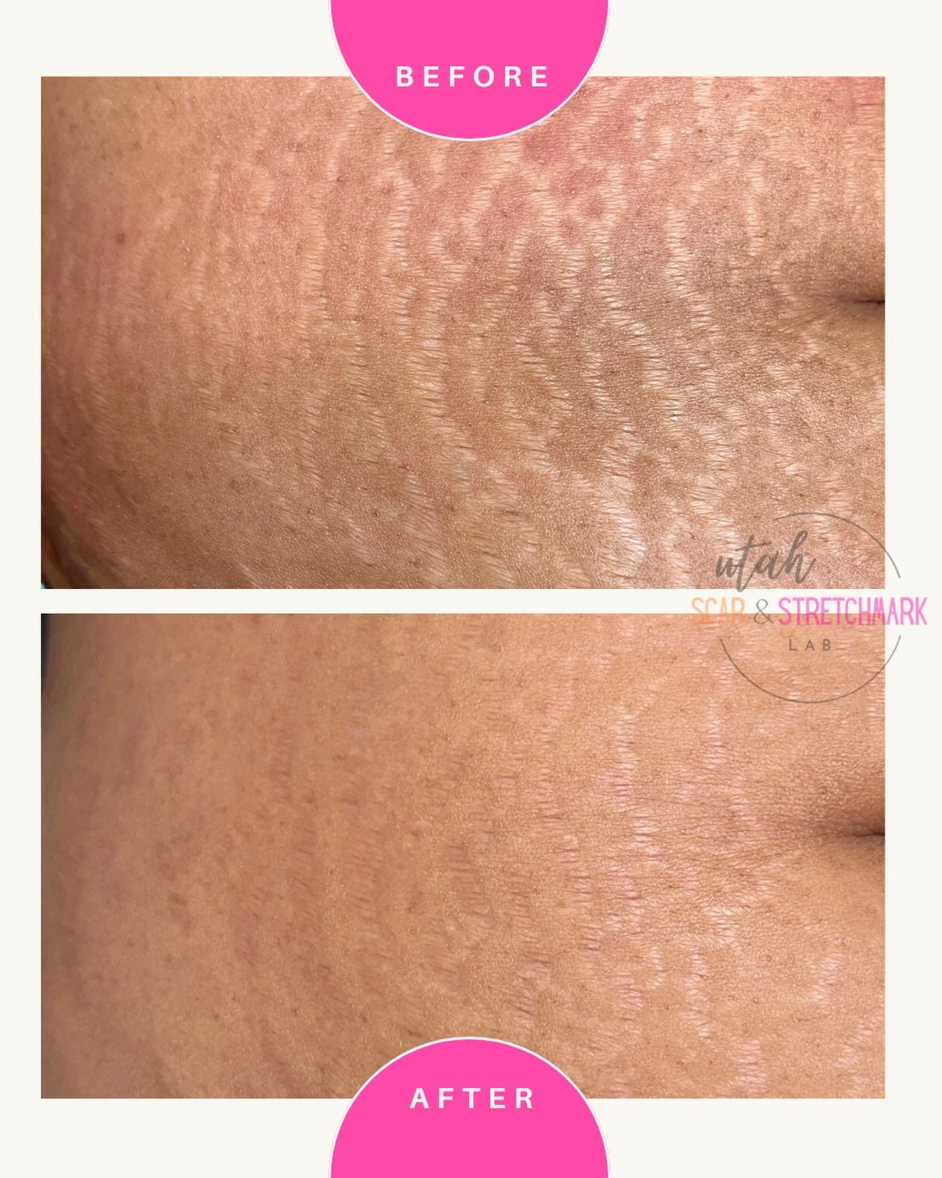 This is the only service where you can tint your stretch marks while also improving the texture. 
All of my before and after photos are taken in the same lighting with the same camera ❤️
#paramedicaltattoo #stretchmarkremoval #stretchmarktattoo