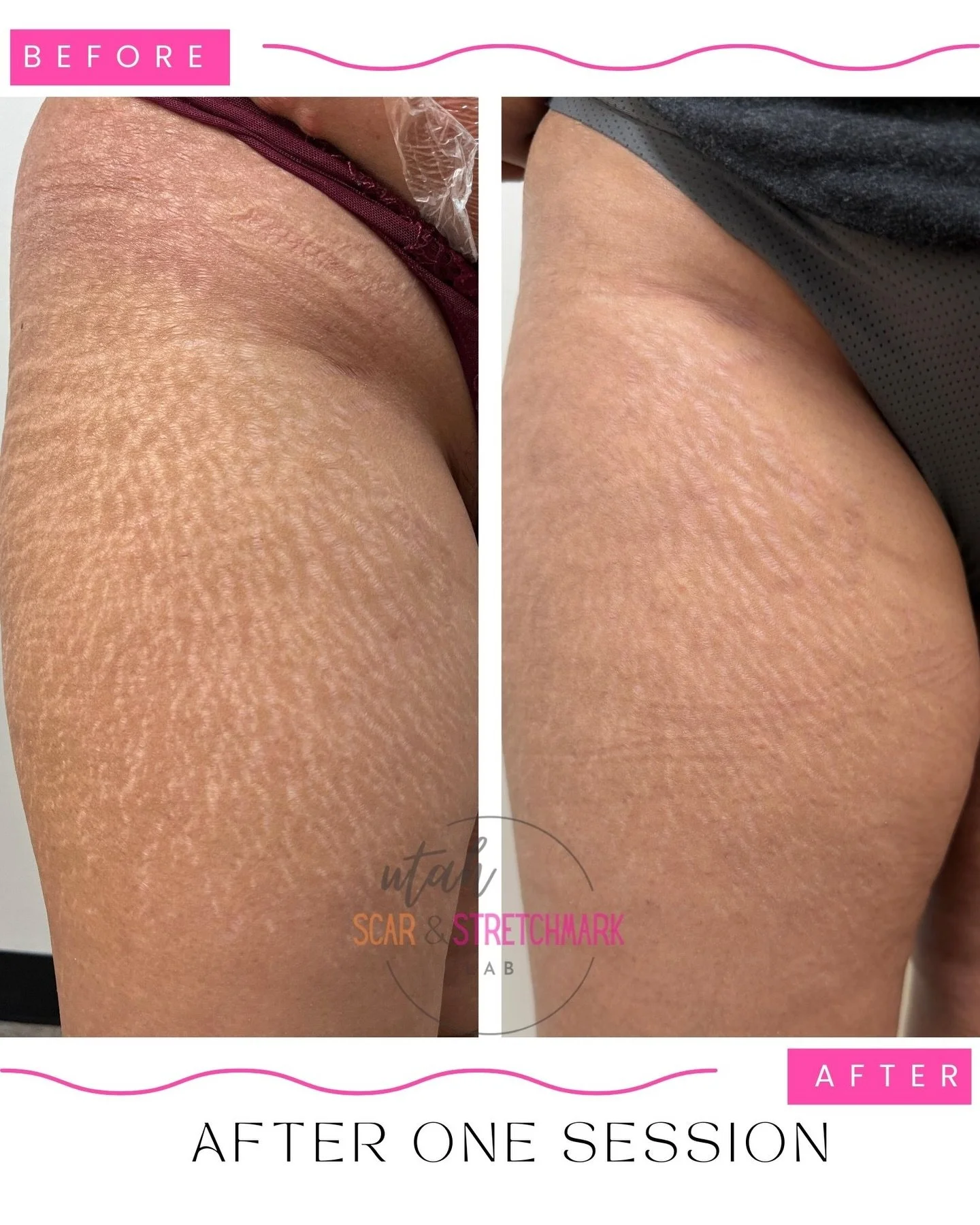 After just ONE session, I have made these high contrast stretch marks far less noticeable.  Paramedical tattoo is one of the only things you can do for your skin to heal texture and add color.  The right artist will use subtle ink to give you natural