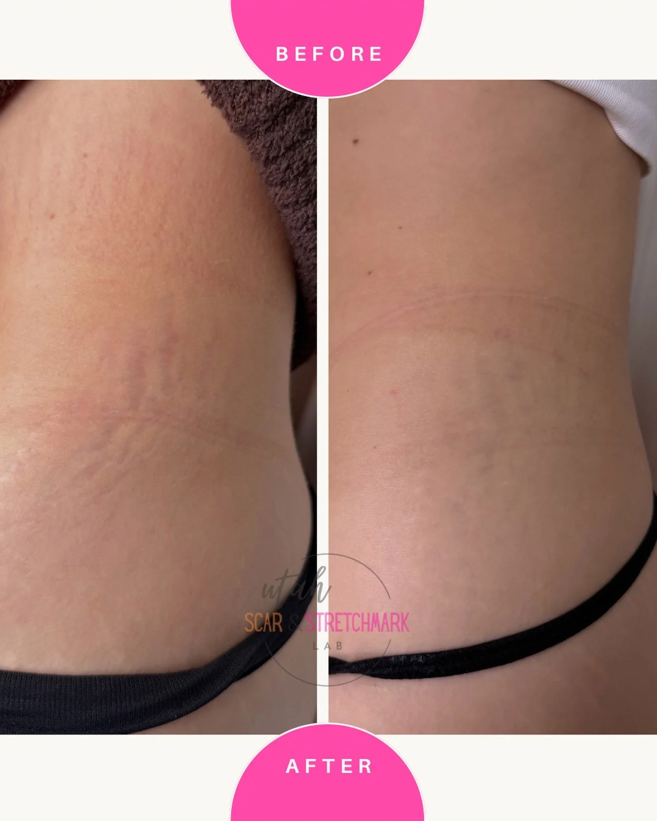 Reminder...A correctly done stretch mark tattoo can tint your stretch marks AND improve the texture.  This is after one session.  To book your appointment, link in my bio or send a DM ❤️
#stretchmarks #stretchmarkremoval #stretchmarksbegone