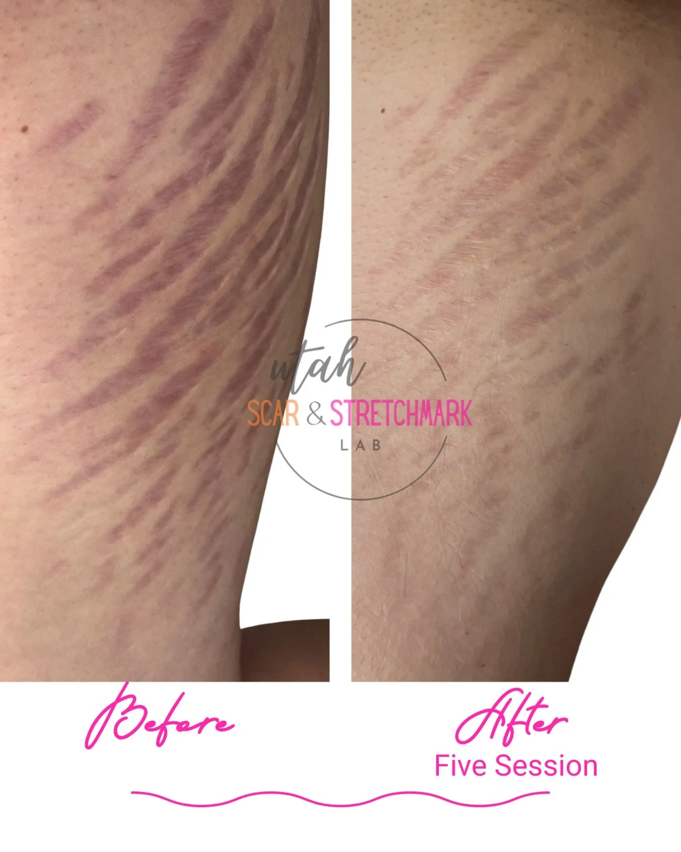For some clients, the journey is long...and trusting the process is key.  After 5 sessions, these stretch marks have made a huge improvement. 

What causes purple stretch marks? 

Purple stretch marks happen when the skin stretches faster than the co