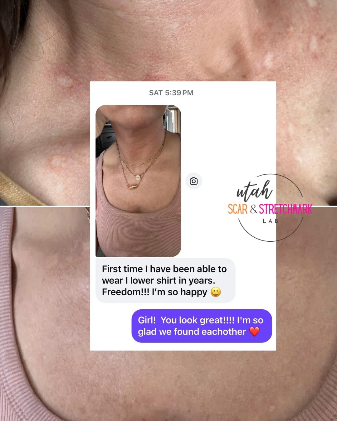 This client came to me after another artist left orange ink inside her scars. We&rsquo;re now three sessions into correcting the work, and the transformation so far has been incredible.

First, we focused on removing the incorrect pigment, then repla