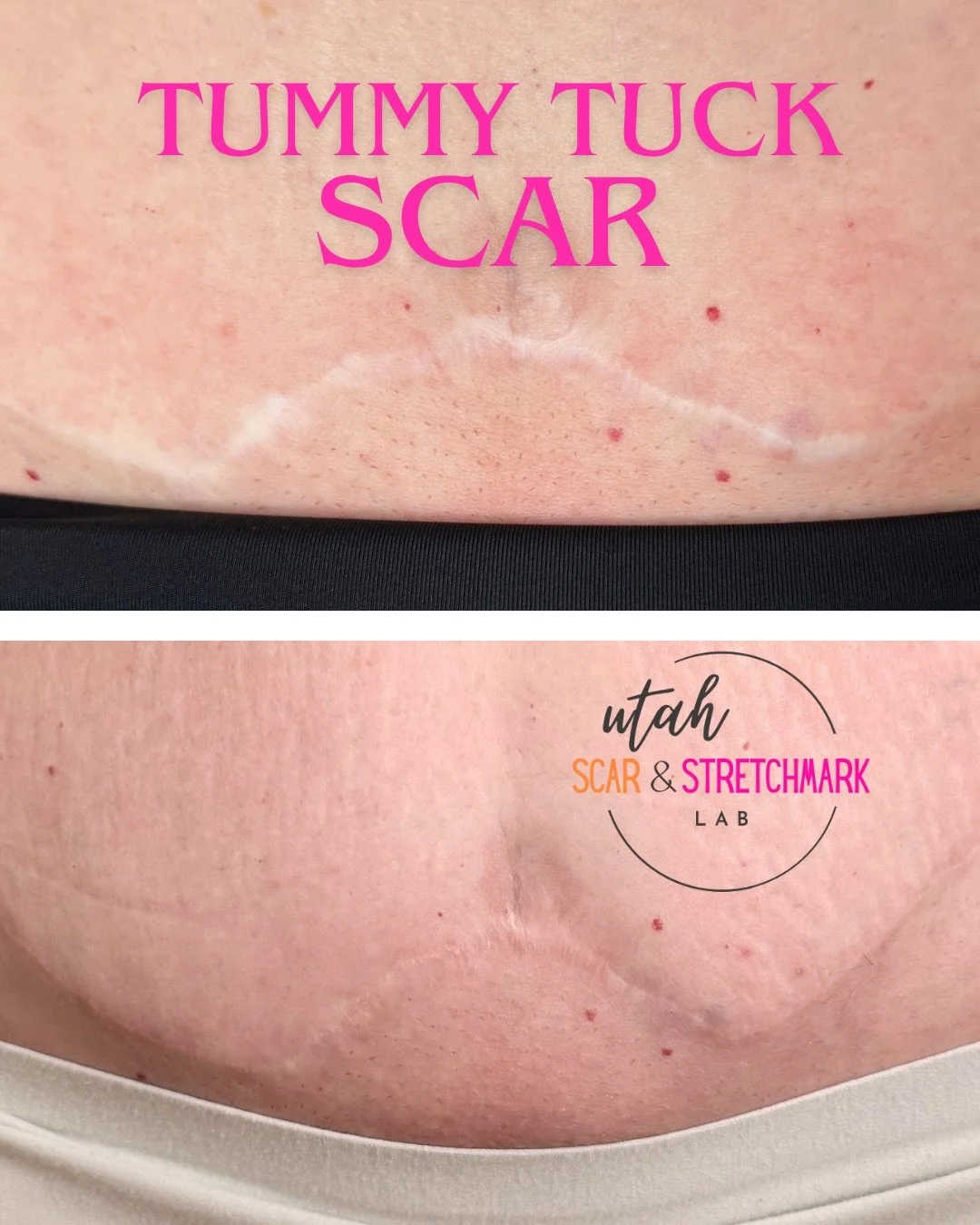 No caption needed. 😘
If you want a tattoo that doesn't oxidize, if you want a trainer that is educated on ink chemistry and natural ink implantation, slide into those DMs ❤️
This tummy tuck tattoo deserves a chefs kiss 😘
Studio located in Ogden, Ut