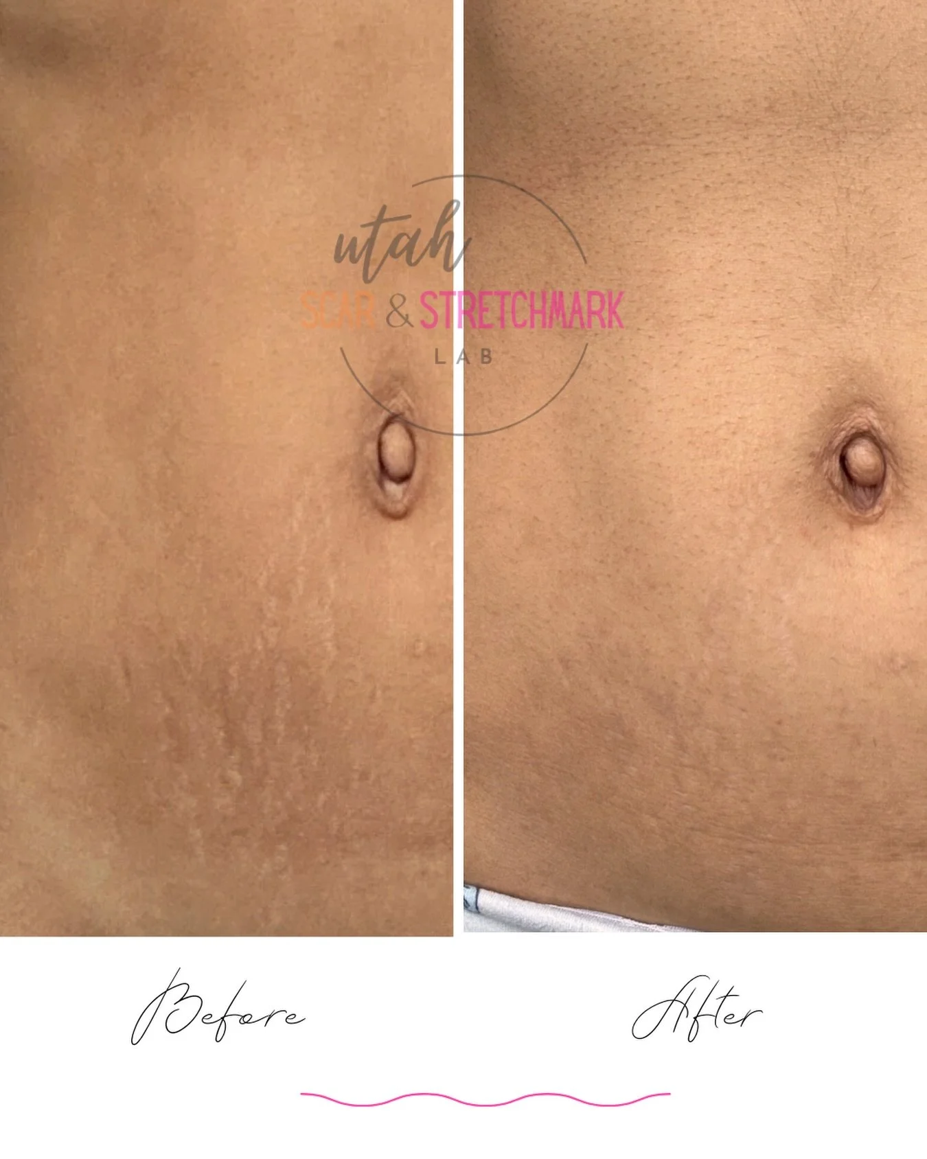 This client came to me after pregnancy. Her skin actually handled the stretching really well, and she only had a few small stretch marks &mdash; but she wanted to see if we could soften them even more.

After 2&ndash;3 stretch mark camouflage tattoo 