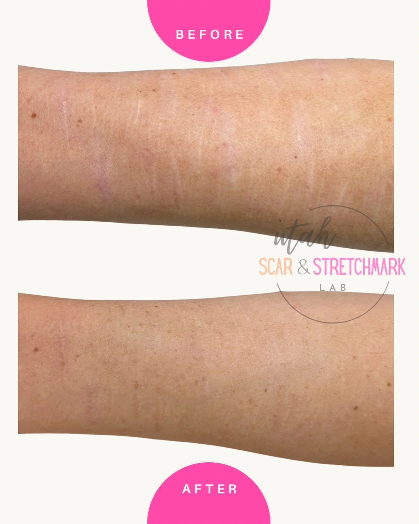 Self harm scars after just ONE session! 
#scarcamouflage #scartreatment #scarremoval