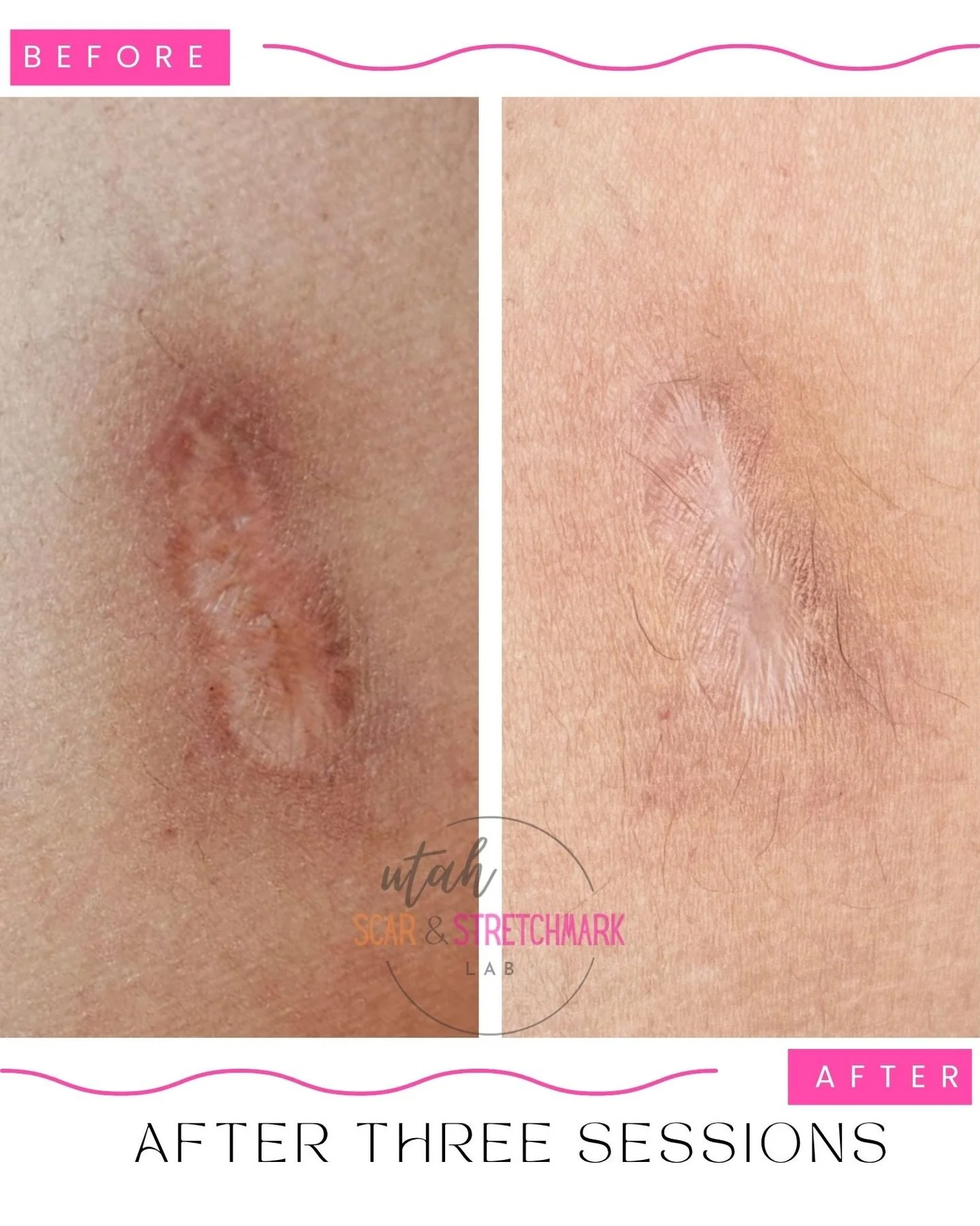 Beautiful result after 3 sessions ❤️